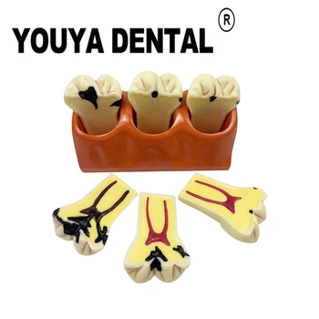 4 פעמים השיניים מודל לפתח עששת שיניים מלמד מודל סטודנטית לרפואת שיניים האימון לומד אוראלי רפואי רפואת שיניים כלים
